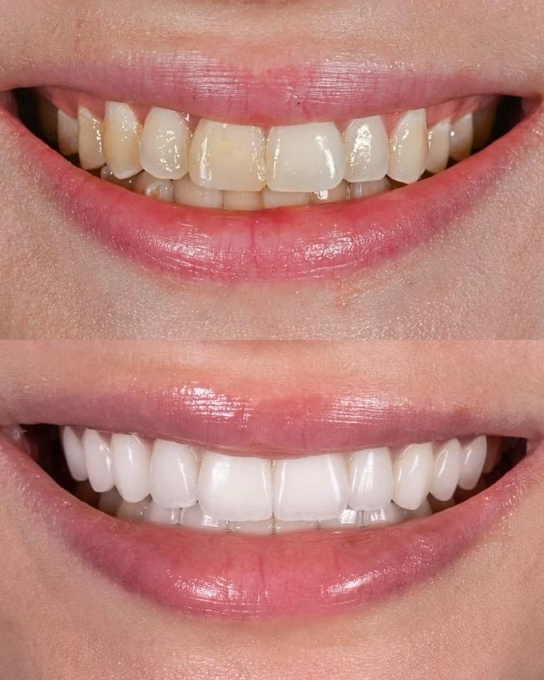 Facettes dentaires : le sourire avant et après le traitement