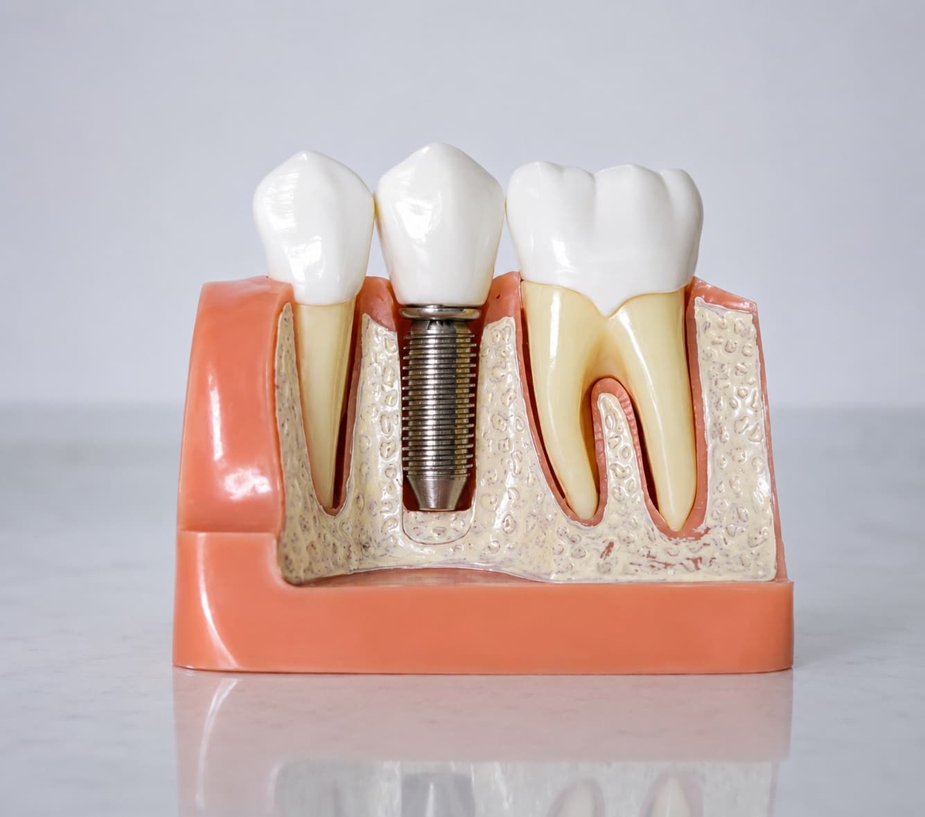 Modèle pédagogique : un implant en titane placé dans l'os, entre deux dents naturelles