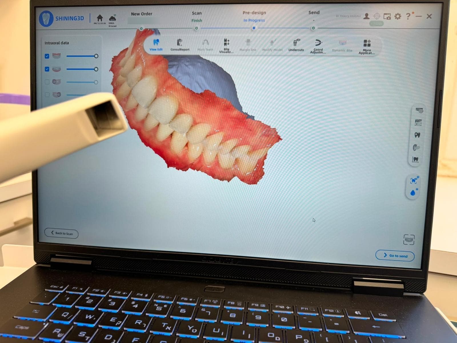Empreinte numérique en cours d'acquisition avec le scanner intra-oral